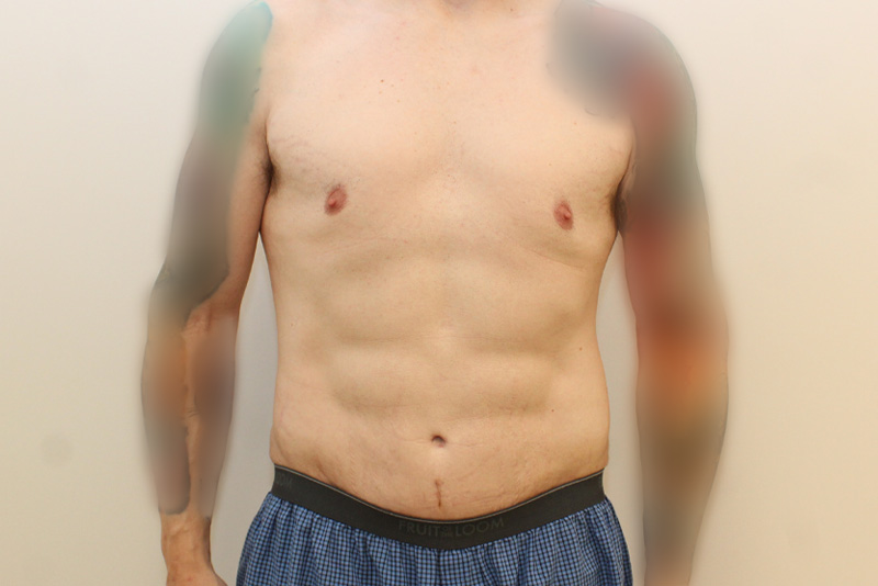 Male Tummy Tuck Before & After Image