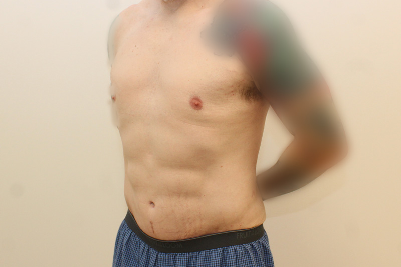Male Tummy Tuck Before & After Image