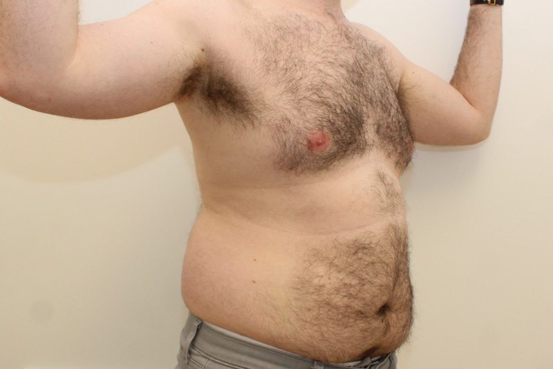 Male Tummy Tuck Before & After Image