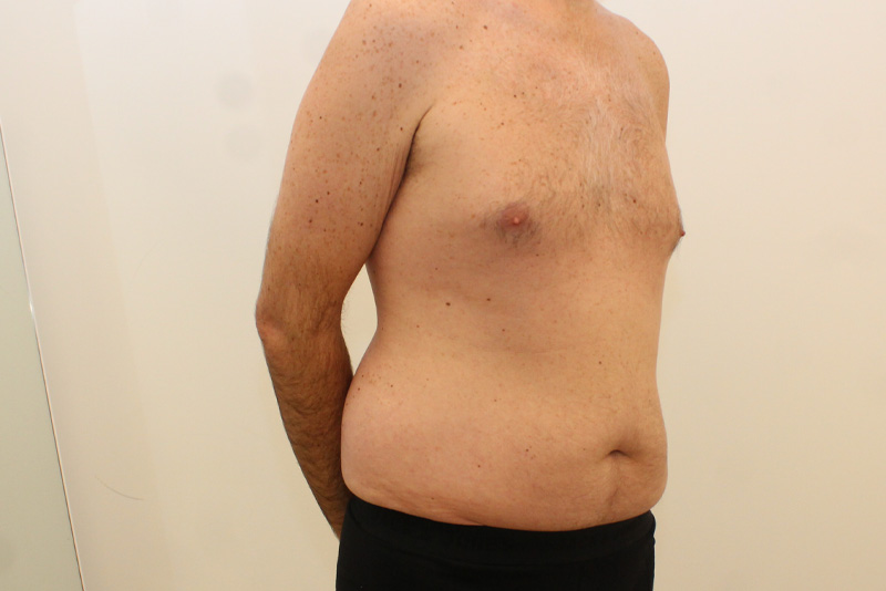 Male Tummy Tuck Before & After Image