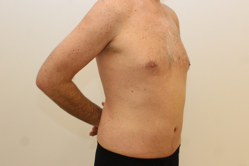 Male Tummy Tuck Before & After Image