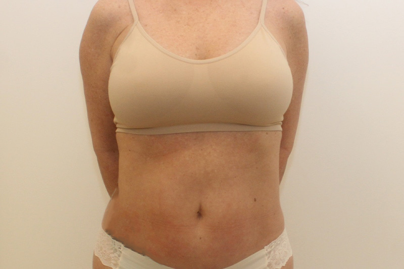 Mini Tummy Tuck Before & After Image