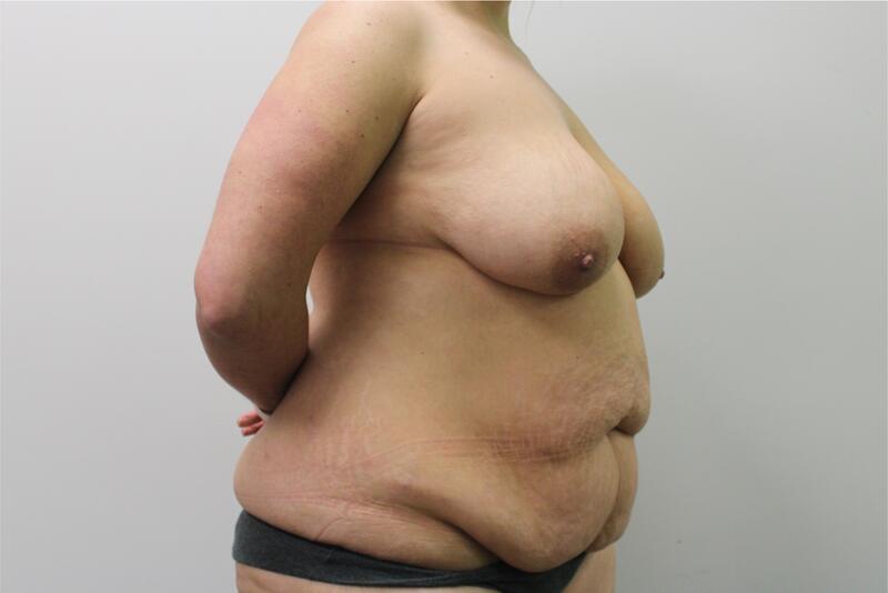 Mommy Makeover Before & After Image