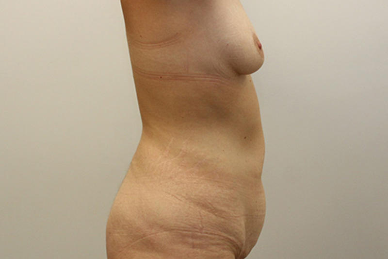 Mommy Makeover Before & After Image