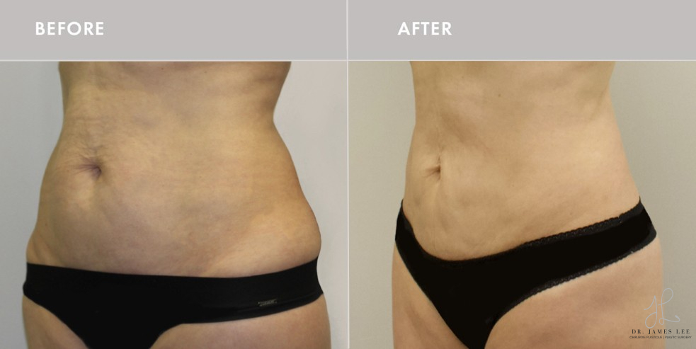 Renuvion Before & After Image