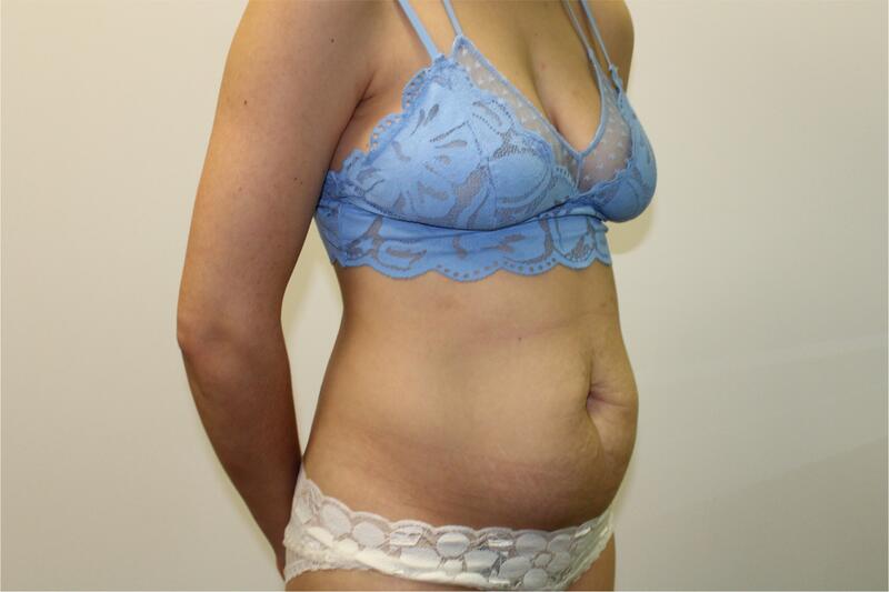 Tummy Tuck Before & After Image