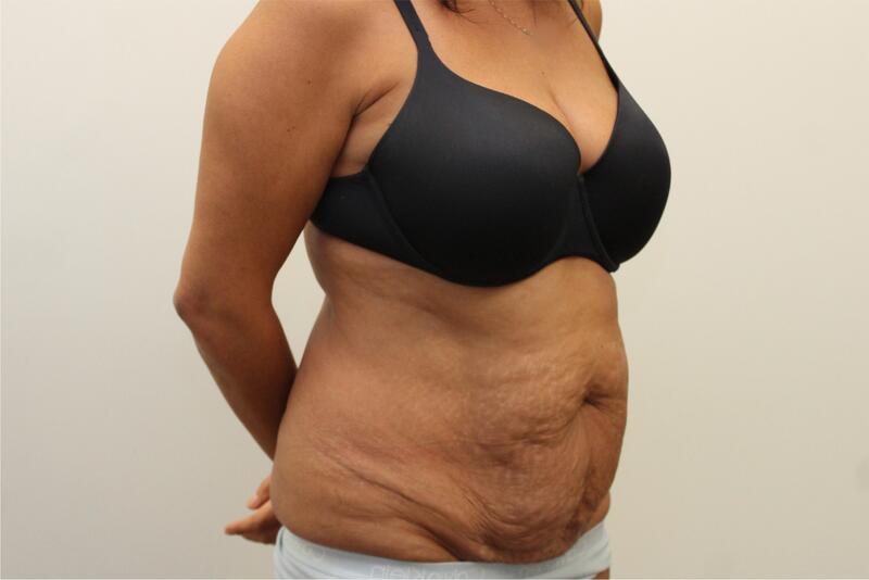 Tummy Tuck Before & After Image