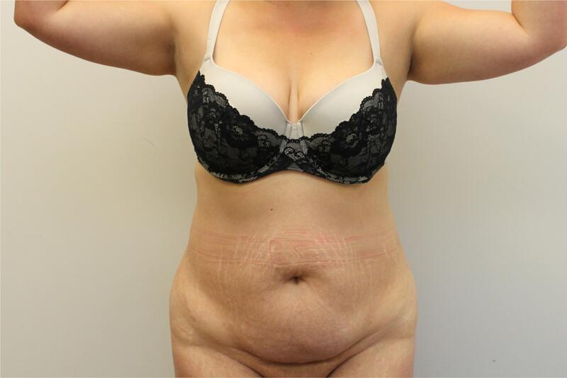 Tummy Tuck Before & After Image