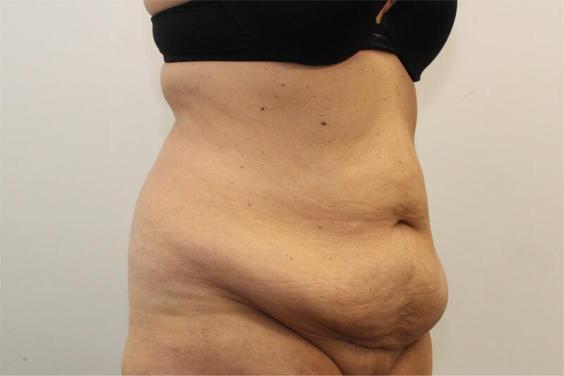 Tummy Tuck Before & After Image
