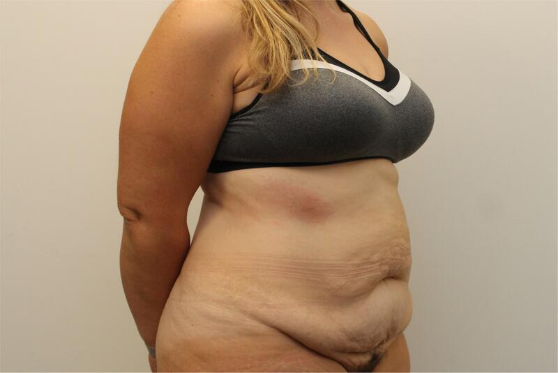 Tummy Tuck Before & After Image
