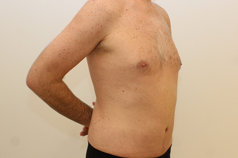 Tummy Tuck Before & After Image