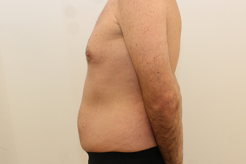 Tummy Tuck Before & After Image