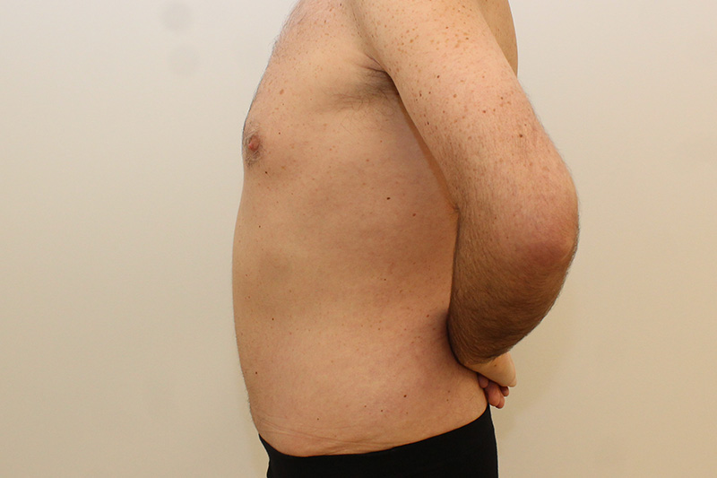 Tummy Tuck Before & After Image