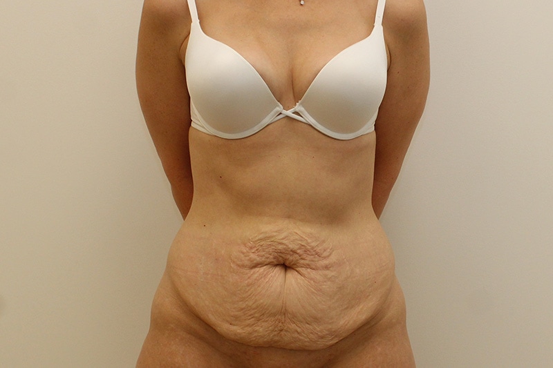 Tummy Tuck Before & After Image