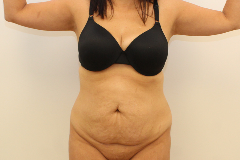 tummy tuck Before & After Image