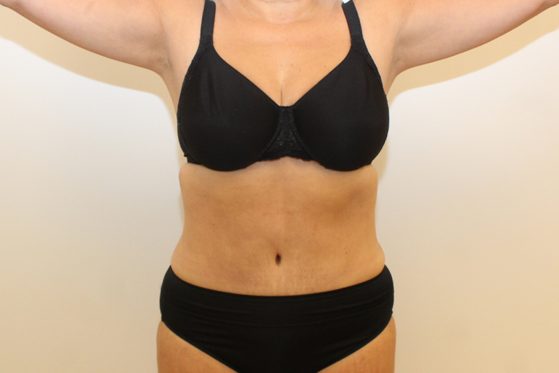 tummy tuck Before & After Image