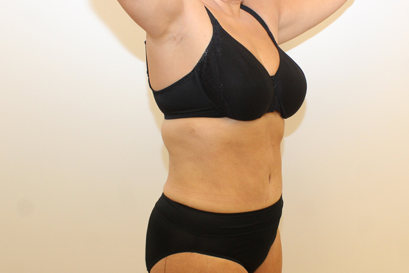 Tummy Tuck Before & After Image