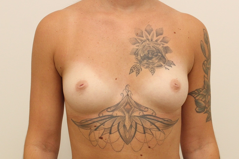 Breast Augmentation Before & After Image