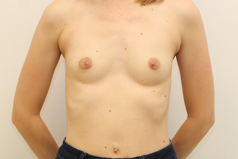 Breast Augmentation Before & After Image