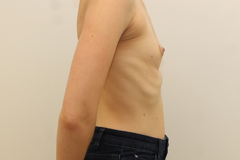Breast Augmentation Before & After Image