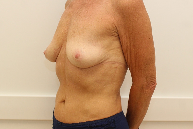 Breast Augmentation Before & After Image