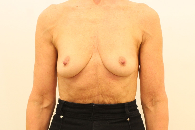 Breast Augmentation Before & After Image