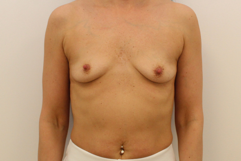 Breast Augmentation Before & After Image