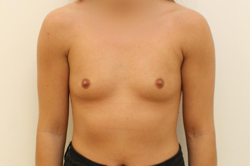 Breast Augmentation Before & After Image