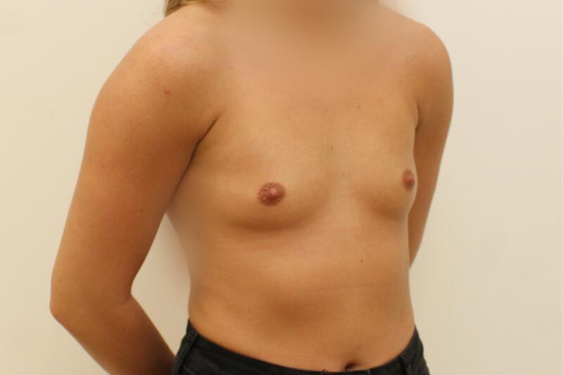 Breast Augmentation Before & After Image