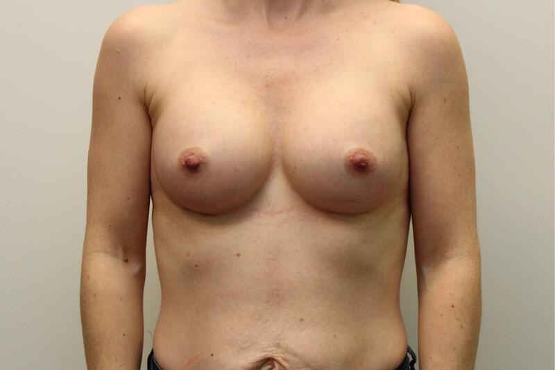 Breast Augmentation Before & After Image