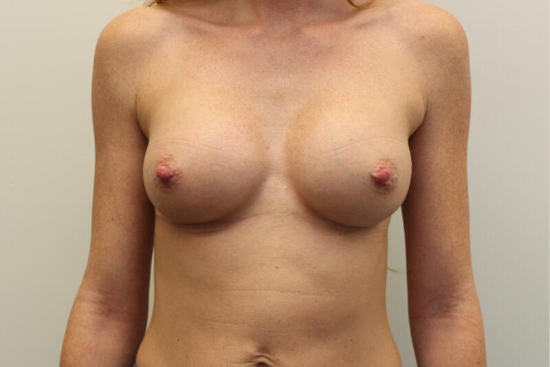 Breast Augmentation Before & After Image