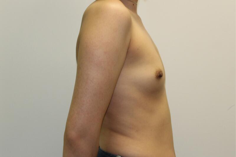Breast Augmentation Before & After Image