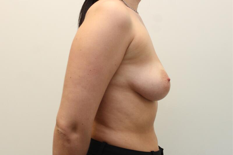 Breast Augmentation Before & After Image