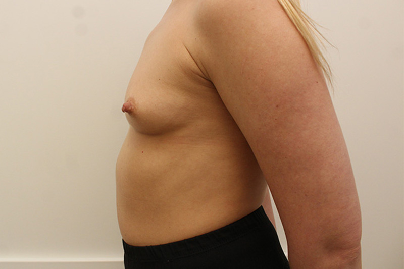 Breast Augmentation Before & After Image