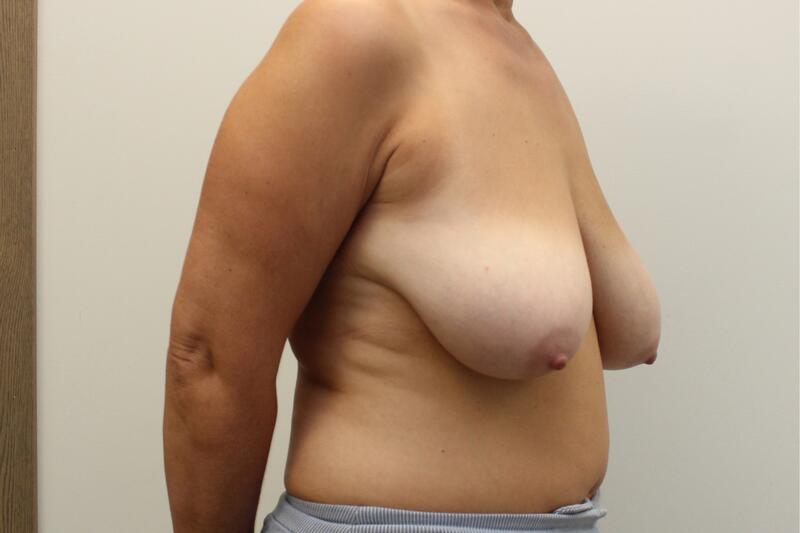 Breast Lift Surgery Before & After Image