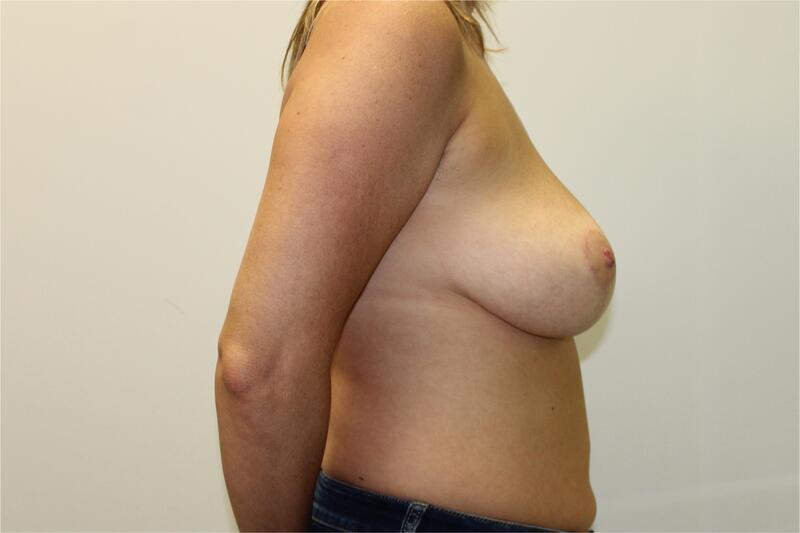 Breast Lift Surgery Before & After Image