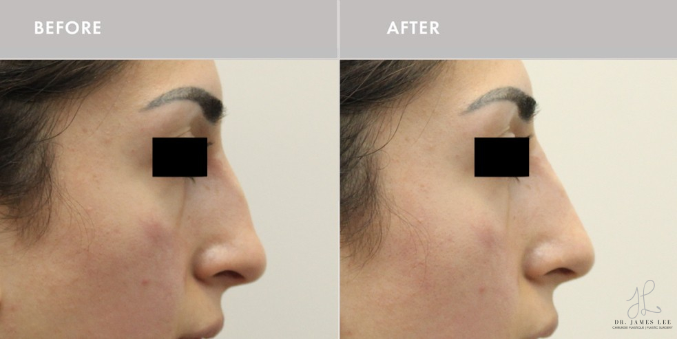 Dermal Fillers Before & After Image