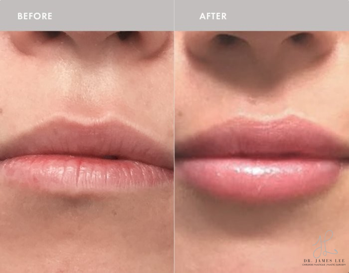 Dermal Fillers Before & After Image