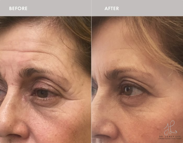 Neuromodulators Before & After Image