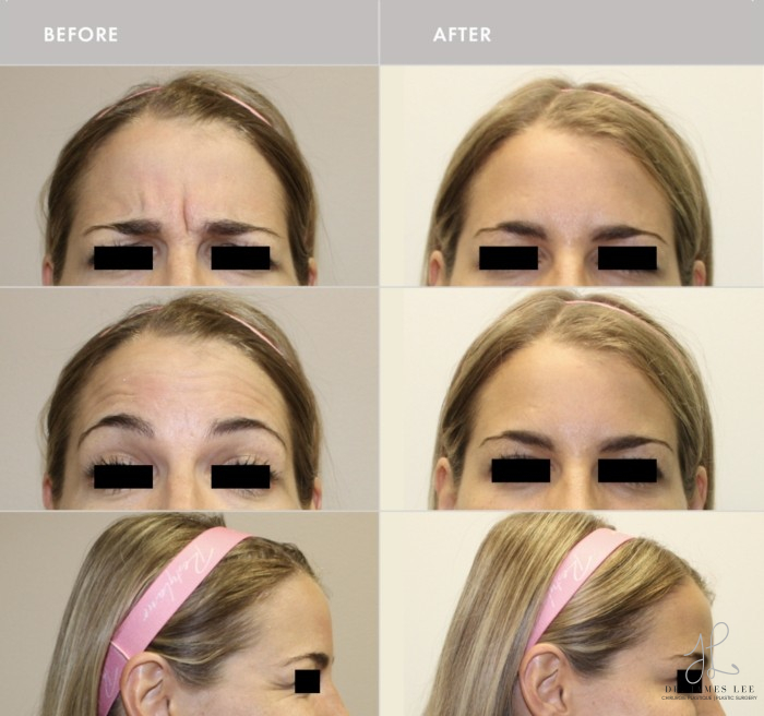 Neuromodulators Before & After Image