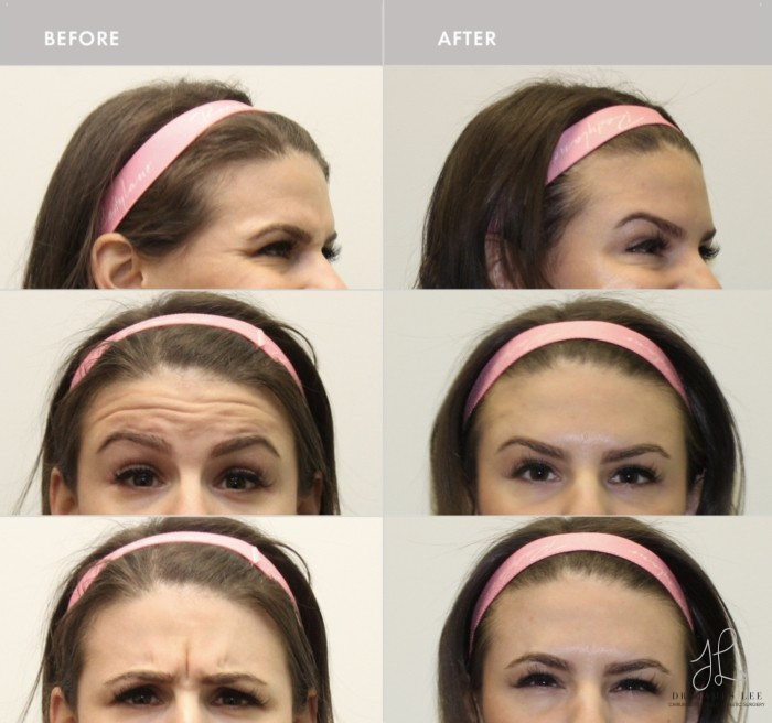 Neuromodulators Before & After Image