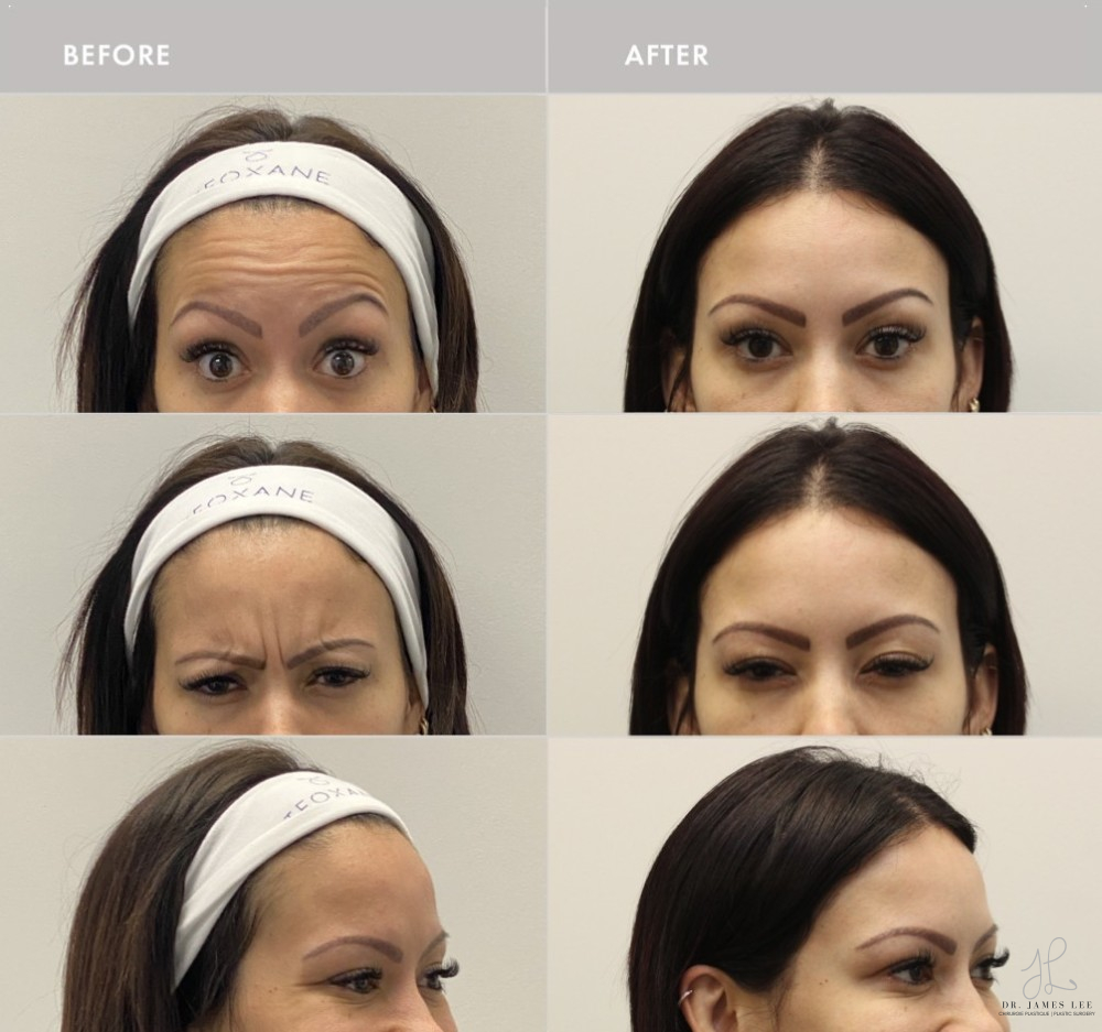 Neuromodulators Before & After Image
